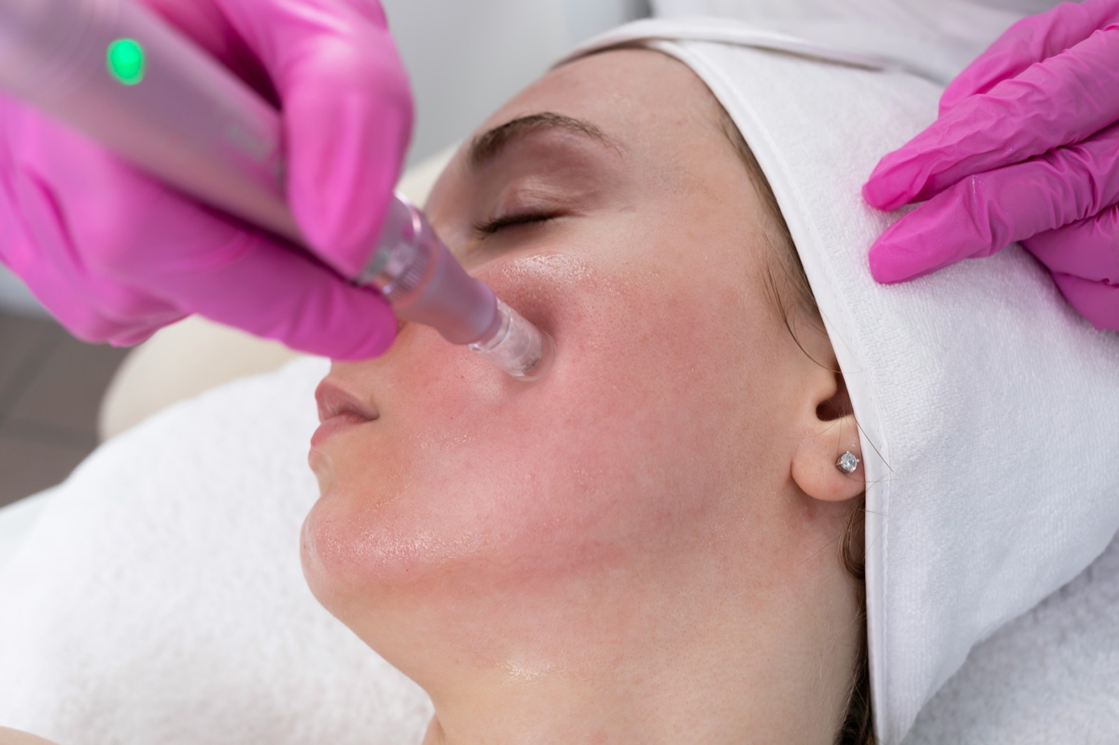 Klassisches Microneedling im Gesicht ohne Radiofrequenz oder Laser