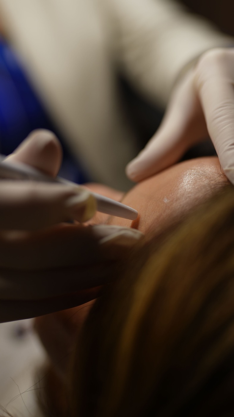 Ärztliche Markierung der Haut vor einer Filler-Behandlung